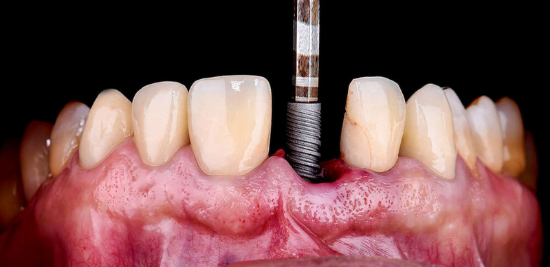 Darf eine PKV Detailangaben zu Implantatmaterialien nach Rechnungslegung fordern?