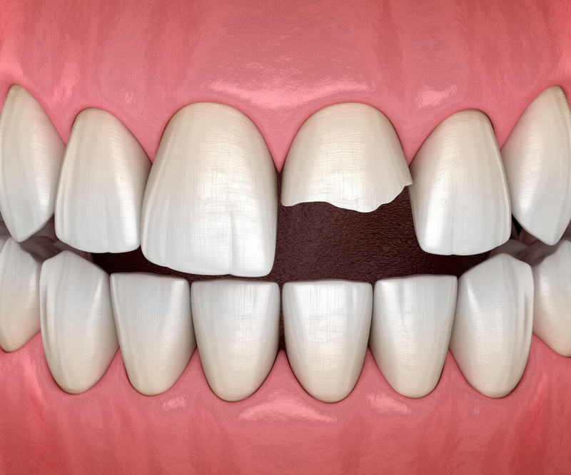 Schulunfall: Wie wird das dentinadhäsive Wiederbefestigen eines abgebrochenen Zahnfragments abgerechnet?