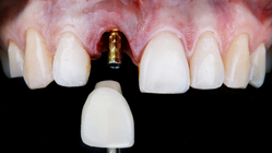 Langzeitdaten zu Einzelkronen auf Implantaten Langzeitdaten zu Einzelkronen auf Implantaten