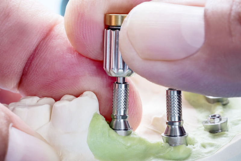 Beihilfefähigkeit von Implantaten ‒ achten Sie auf die länderspezifischen Details!