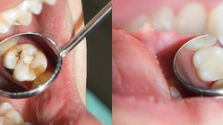 Initialläsionen: Kombination von Peptid P11-4 und Fluorid stärkt den Zahnschmelz Initialläsionen: Kombination von Peptid P11-4 und Fluorid stärkt den Zahnschmelz