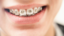 Wie klebt man Keramikbrackets auf Keramikkronen? Wie klebt man Keramikbrackets auf Keramikkronen?