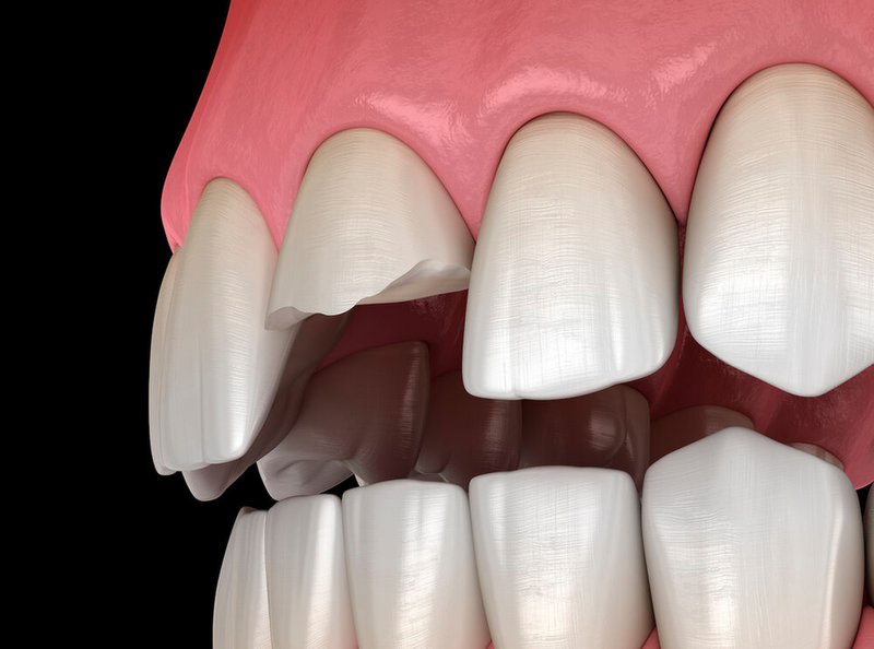 Therapie dentaler Traumata bleibender Zähne: S2k-Leitlinie aktualisiert
