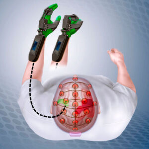 Diagramm der sogenannten "Ipsihand" im Einsatz: Das Gerät spürt Impulse im unbeschädigten Bereich des Schlaganfallpatienten (grün dargestellt), was dazu führt, dass sich die Plastikschiene an der Hand entsprechend öffnet und schließt. Durch stetige Wiederholung hilft die Ipsihand die heilen Gehirnbereiche zu trainieren und nach und nach Funktionen zu übernehmen, die zuvor von den durch den Schlaganfall beschädigten Hirnzellen durchgeführt wurden. Diagramm der sogenannten "Ipsihand" im Einsatz: Das Gerät spürt Impulse im unbeschädigten Bereich des Schlaganfallpatienten (grün dargestellt), was dazu führt, dass sich die Plastikschiene an der Hand entsprechend öffnet und schließt. Durch stetige Wiederholung hilft die Ipsihand die heilen Gehirnbereiche zu trainieren und nach und nach Funktionen zu übernehmen, die zuvor von den durch den Schlaganfall beschädigten Hirnzellen durchgeführt wurden.