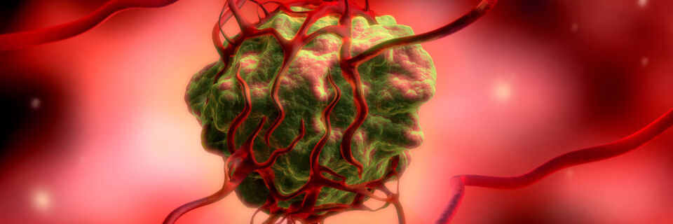 Krebsgeschwüre sind in der Regel stärker arteriell durchblutet als gesundes Gewebe. Deshalb sollen sich die strahlenden Kügelchen vor allem im Tumor anreichern. Krebsgeschwüre sind in der Regel stärker arteriell durchblutet als gesundes Gewebe. Deshalb sollen sich die strahlenden Kügelchen vor allem im Tumor anreichern.