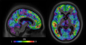 Forscher der kanadischen McGill Universität entwickelten mit Hilfe von KI einen Algorithmus, mit dem sich die Anzeichen einer Alzheimer-Erkrankung zwei Jahre bevor diese einsetzt, erkennen lassen könnte. Forscher der kanadischen McGill Universität entwickelten mit Hilfe von KI einen Algorithmus, mit dem sich die Anzeichen einer Alzheimer-Erkrankung zwei Jahre bevor diese einsetzt, erkennen lassen könnte.