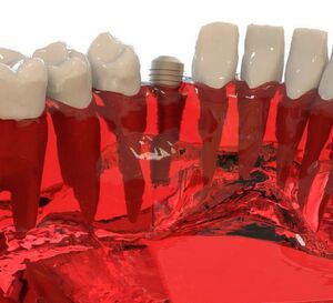 Zahnimplantate werden dauerhaft im Kieferknochen implantiert. Das komplette Implantat besteht in der Regel aus drei Teilen: künstliche Zahnwurzel (im Bild), die im Kieferknochen verankert wird, Verbindungsstück (das sogenannte Abutment) und sichtbarer Zahnersatz . Zahnimplantate werden dauerhaft im Kieferknochen implantiert. Das komplette Implantat besteht in der Regel aus drei Teilen: künstliche Zahnwurzel (im Bild), die im Kieferknochen verankert wird, Verbindungsstück (das sogenannte Abutment) und sichtbarer Zahnersatz .