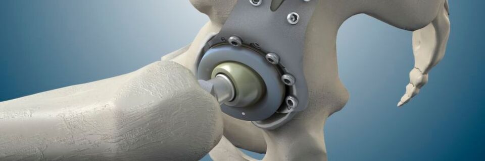 Die Implantation einer Hüft-Endoprothese ist eine enorme Belastung für den Patienten. Hier im Modell zu sehen: ein modulare Revisions-Stützpfanne für den Hüftgelenkersatz. Die Implantation einer Hüft-Endoprothese ist eine enorme Belastung für den Patienten. Hier im Modell zu sehen: ein modulare Revisions-Stützpfanne für den Hüftgelenkersatz.