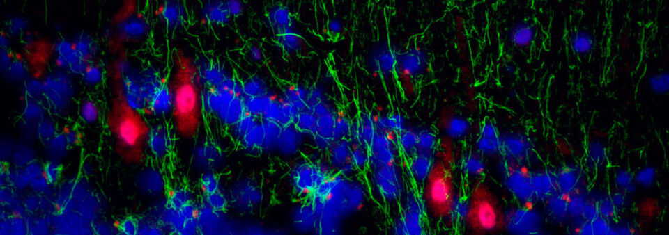 Immunfluoreszenzaufnahme aus der Kleinhirnrindenregion von bipolaren Patienten, die Proteine von humanen Herpesviren (rot) in Purkinje-Neuronen zeigen. Astrozyten sind grün gefärbt. Immunfluoreszenzaufnahme aus der Kleinhirnrindenregion von bipolaren Patienten, die Proteine von humanen Herpesviren (rot) in Purkinje-Neuronen zeigen. Astrozyten sind grün gefärbt.