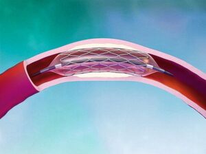 Ein Stent dient zum Offenhalten und zur Erweiterung von Gefäßen und Hohlorganen. Genaugenommen stabilisiert ein Stent Gefäße nach deren Erweiterung, vor allem an den Herzkranzgefäßen. Ein Stent dient zum Offenhalten und zur Erweiterung von Gefäßen und Hohlorganen. Genaugenommen stabilisiert ein Stent Gefäße nach deren Erweiterung, vor allem an den Herzkranzgefäßen.