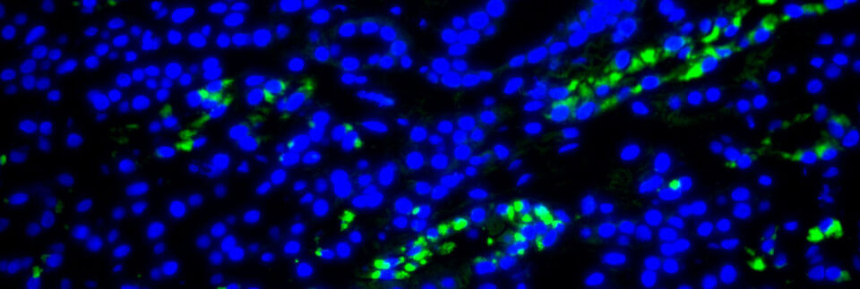 95 bis 100 Prozent der gesunden Erwachsenen sind mit einer Variante des menschlichen Herpesvirus 6 (HHV-6) infiziert. Normalerweise inaktiv und harmlos können diese Herpesviren z.B. durch Gabe spezieller Medikamente rekativiert werden. Im Bild: Fluoreszenzaufnahme aus der Nierenbiopsie der DRESS-Patientin mit HHV-6-kodierter sncRNA-U14 (grün). Die DNA wurde blau gefärbt. 95 bis 100 Prozent der gesunden Erwachsenen sind mit einer Variante des menschlichen Herpesvirus 6 (HHV-6) infiziert. Normalerweise inaktiv und harmlos können diese Herpesviren z.B. durch Gabe spezieller Medikamente rekativiert werden. Im Bild: Fluoreszenzaufnahme aus der Nierenbiopsie der DRESS-Patientin mit HHV-6-kodierter sncRNA-U14 (grün). Die DNA wurde blau gefärbt.
