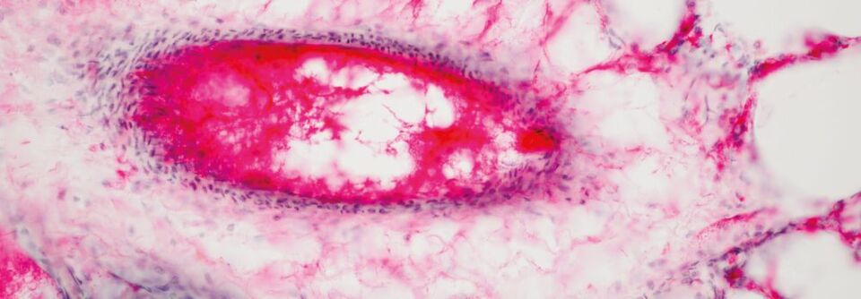 Abb. 1: Krebsdiagnostik: Ob Gewebe bösartig entartet ist, wird häufig anhand einer dem Körper entnommenen Gewebeprobe beurteilt. Im Bild: mikroskopische Darstellung von menschlichem Lungengewebe. Abb. 1: Krebsdiagnostik: Ob Gewebe bösartig entartet ist, wird häufig anhand einer dem Körper entnommenen Gewebeprobe beurteilt. Im Bild: mikroskopische Darstellung von menschlichem Lungengewebe.
