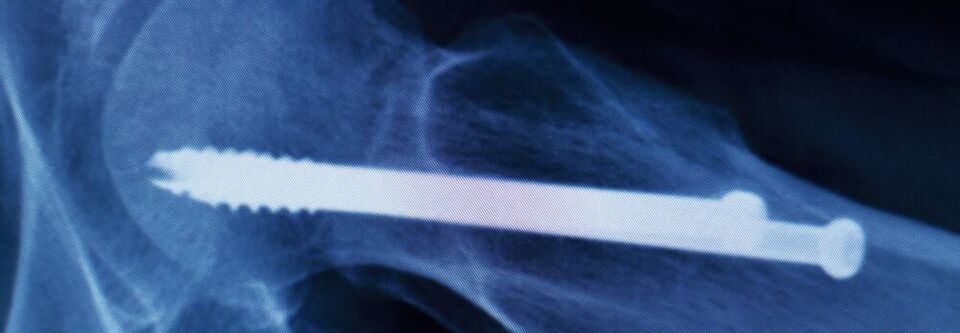 Abb. 1: Sie stabilisieren beispielsweise verletzte Knochen und ermöglichen so deren Heilung: Medizinische Implantate Abb. 1: Sie stabilisieren beispielsweise verletzte Knochen und ermöglichen so deren Heilung: Medizinische Implantate