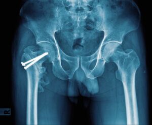 Eine Knochenschraube wird immer dann eingesetzt, wenn eine Fraktur ohne zusätzliche Fixierung nicht ordentlich verheilen würde. Knochenschrauben können in verschiedenen anatomischen Regionen eingesetzt werden, kommen aber insbesondere bei gelenknahen Brüchen zum Einsatz, etwa an der Hüfte. Eine Knochenschraube wird immer dann eingesetzt, wenn eine Fraktur ohne zusätzliche Fixierung nicht ordentlich verheilen würde. Knochenschrauben können in verschiedenen anatomischen Regionen eingesetzt werden, kommen aber insbesondere bei gelenknahen Brüchen zum Einsatz, etwa an der Hüfte.