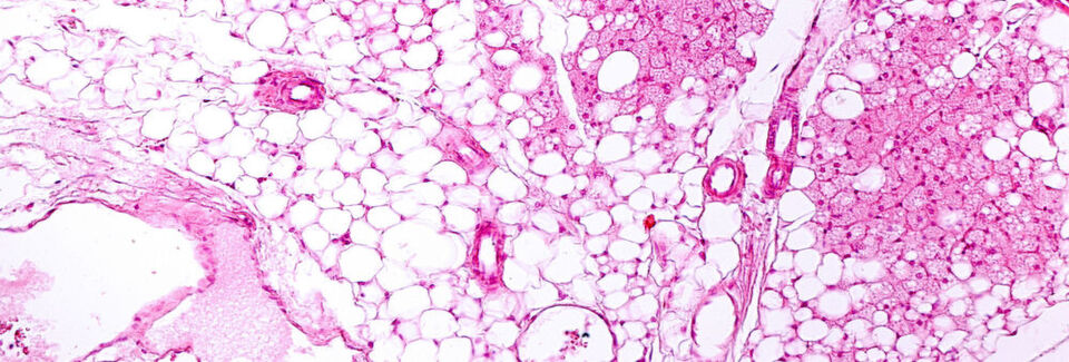 Statine senken das Cholesterin und reduzieren dabei braunes Fettgewebe. Im Bild braunes und weißes Fettgewebe. Statine senken das Cholesterin und reduzieren dabei braunes Fettgewebe. Im Bild braunes und weißes Fettgewebe.