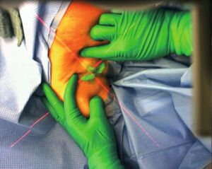 Die exakte Position eines Lymphknotens wird dem Arzt während der Operation über eine Augmented-Reality-Brille eingeblendet. Die exakte Position eines Lymphknotens wird dem Arzt während der Operation über eine Augmented-Reality-Brille eingeblendet.