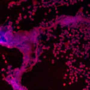 This image shows the white blood cells (neutrophils) in the spinal fluid during bacterial meningitis. The nuclear material DNA is marked blue and proteins in neutrophils are colored in red. The large aggregates as represented by overlapping areas of blue (DNA) and red (protein) portrays the extracellular DNA-protein networks called neutrophil extracellular traps (NETs). This image shows the white blood cells (neutrophils) in the spinal fluid during bacterial meningitis. The nuclear material DNA is marked blue and proteins in neutrophils are colored in red. The large aggregates as represented by overlapping areas of blue (DNA) and red (protein) portrays the extracellular DNA-protein networks called neutrophil extracellular traps (NETs).