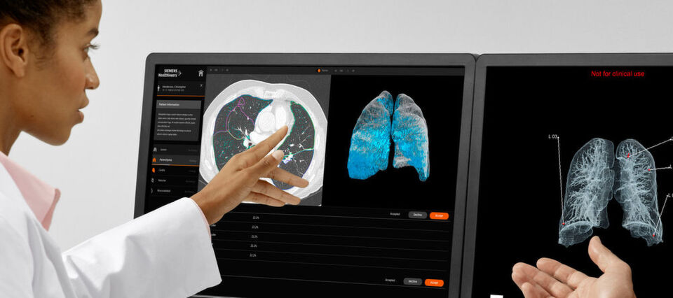 AI-Rad Companion Chest CT ist eine auf künstlicher Intelligenz (KI) basierende Software für die Computertomografie (CT). Die zugrundeliegenden Algorithmen wurden in Wissenschaftsteams bei Siemens Healthineers anhand von umfangreichen klinischen Datensätzen trainiert. AI-Rad Companion Chest CT ist eine auf künstlicher Intelligenz (KI) basierende Software für die Computertomografie (CT). Die zugrundeliegenden Algorithmen wurden in Wissenschaftsteams bei Siemens Healthineers anhand von umfangreichen klinischen Datensätzen trainiert.