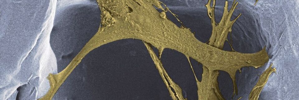 Im Gerüst des Polymerschaums finden Zellen Halt, um neues Hautgewebe aufzubauen. Im Gerüst des Polymerschaums finden Zellen Halt, um neues Hautgewebe aufzubauen.