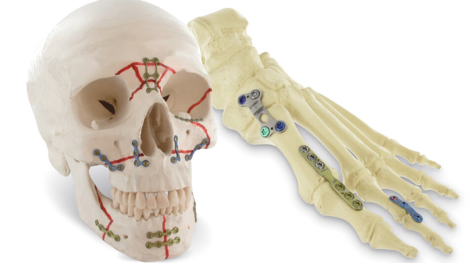 Von Kopf bis Fuß: Bei der Arno Fritz GmbH, einem Hersteller von Implantaten und Instrumenten für die MKG-, Hand- und Fußchirurgie, sorgt eine ERP/MES-Branchenlösung für die Medizintechnik durchgängig für Transparenz und Rückverfolgbarkeit. Von Kopf bis Fuß: Bei der Arno Fritz GmbH, einem Hersteller von Implantaten und Instrumenten für die MKG-, Hand- und Fußchirurgie, sorgt eine ERP/MES-Branchenlösung für die Medizintechnik durchgängig für Transparenz und Rückverfolgbarkeit.