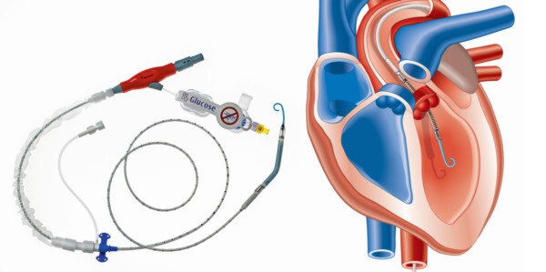 System Impella: Die Pumpe fördert kontinuierlich bis fünf Liter Blut in der Minute aus der linken Herzkammer über die Aortenklappe in die Hauptschlagader. System Impella: Die Pumpe fördert kontinuierlich bis fünf Liter Blut in der Minute aus der linken Herzkammer über die Aortenklappe in die Hauptschlagader.